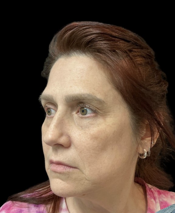 
 before treatment stacking at Juvly Aesthetics