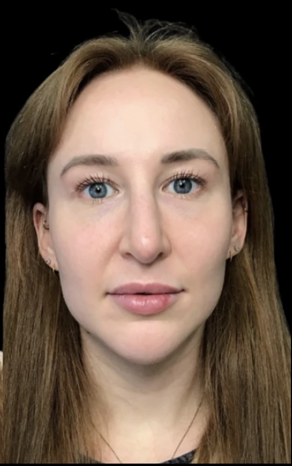 Under-Eye Treatments after treatment at Juvly Aesthetics
