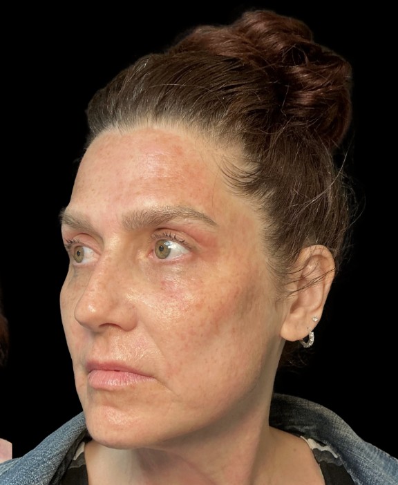 
 after treatment stacking at Juvly Aesthetics