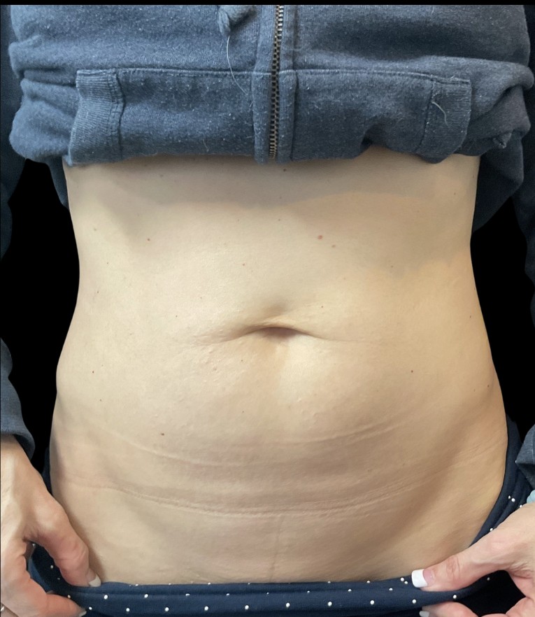 Sylfirm X after treatment at Juvly Aesthetics