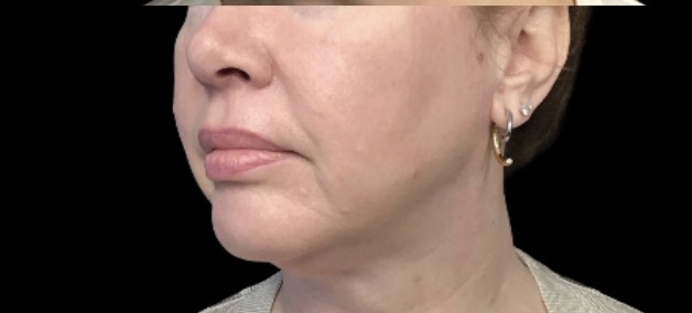 Sylfirm X after treatment at Juvly Aesthetics
