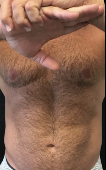 Kybella after treatment at Juvly Aesthetics