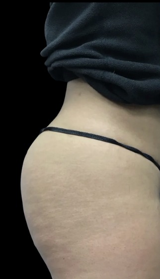Non-Surgical BBL before treatment at Juvly Aesthetics