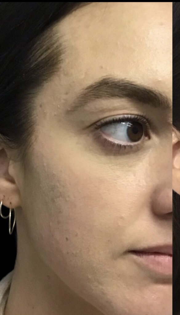 Standard Microneedling before treatment at Juvly Aesthetics