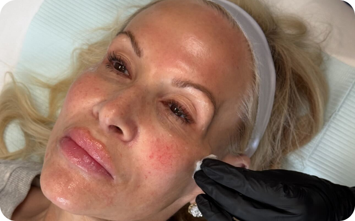 Elite Chemical Peel at Juvly Aesthetics