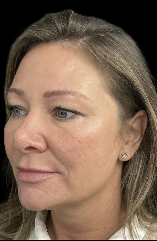 Sylfirm X after treatment at Juvly Aesthetics