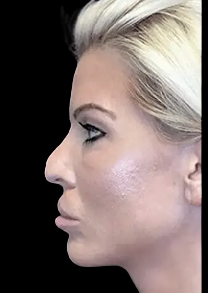 Liquid Nose Job before treatment at Juvly Aesthetics