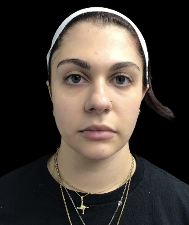 Under-Eye Treatments before treatment at Juvly Aesthetics