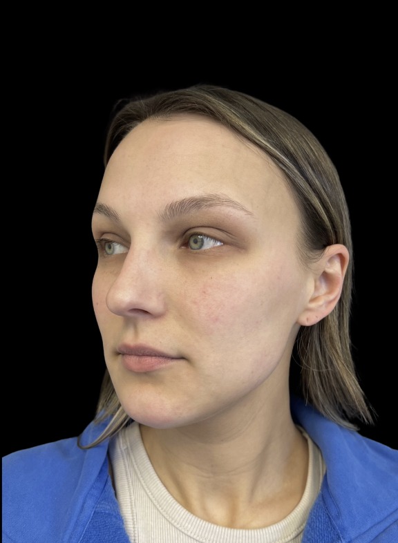 JLyft Non-Surgical Facelift before treatment at Juvly Aesthetics
