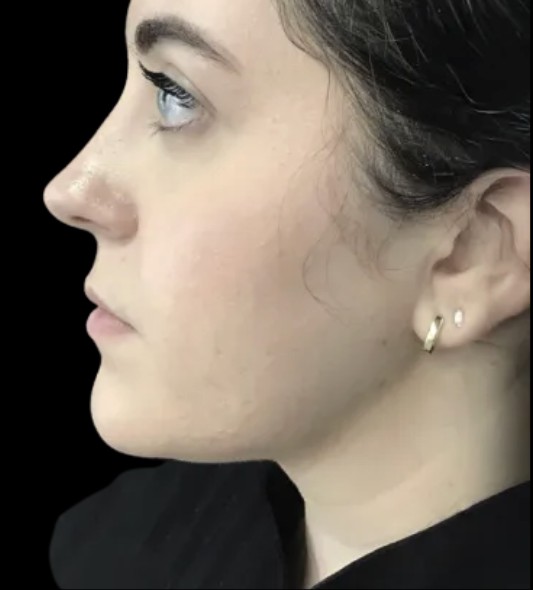 CoolSculpting Submental after treatment at Juvly Aesthetics