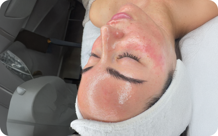 Intensive Chemical Peel at Juvly Aesthetics