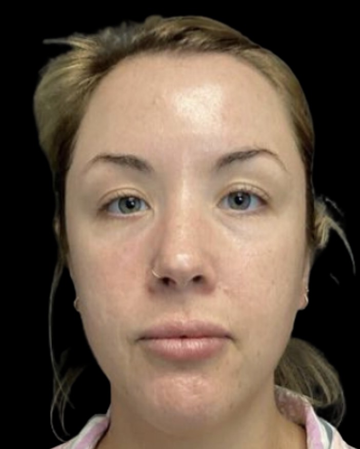 Chemical Peel after treatment at Juvly Aesthetics
