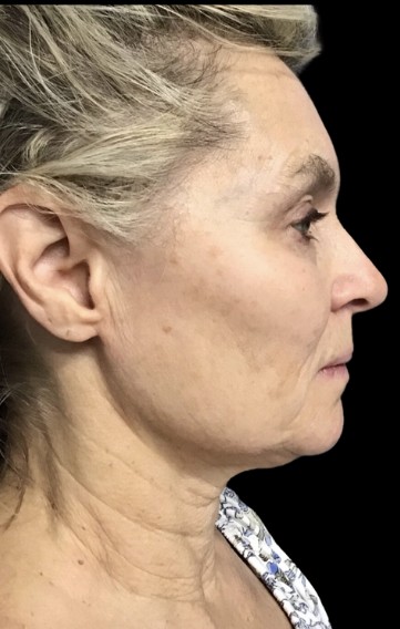 Sylfirm X after treatment at Juvly Aesthetics