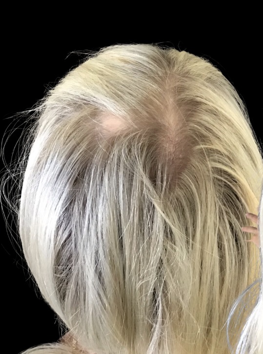 Hair Loss Treatments before treatment at Juvly Aesthetics