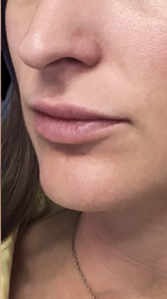Lip filler after treatment at Juvly Aesthetics