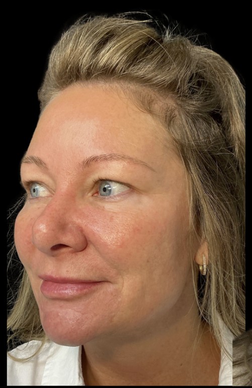 Sylfirm X before treatment at Juvly Aesthetics