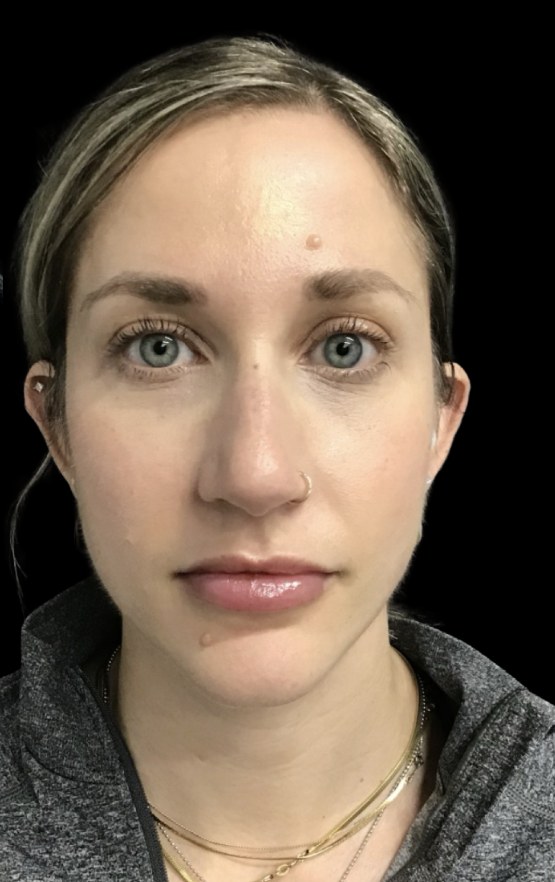 JLyft Non-Surgical Facelift after treatment at Juvly Aesthetics