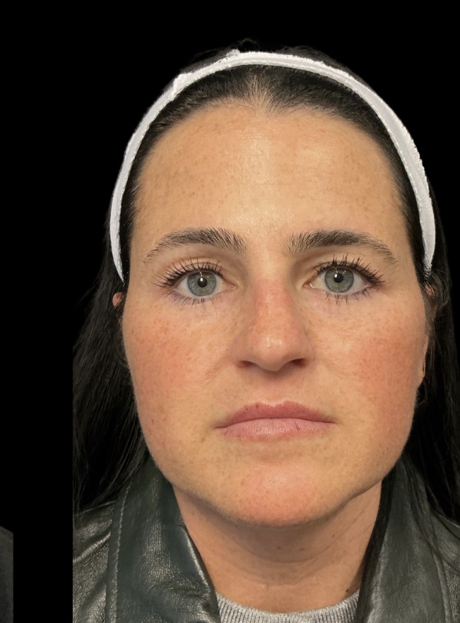 Masseter slimming before treatment at Juvly Aesthetics