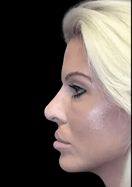 Liquid Nose Job after treatment at Juvly Aesthetics