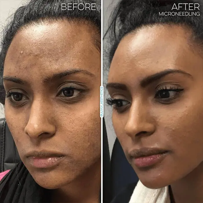 skin-resurfacing-microneedling-woman