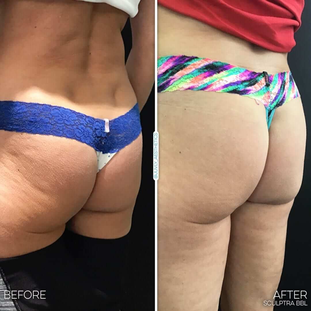 Beach Booty Lift  Nonsurgical BBL - Dr. Clevens