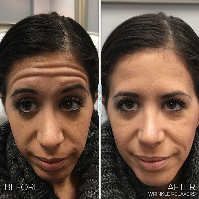 before and after at med spa cleveland