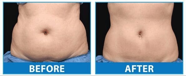 What To Expect Before, During & After A CoolSculpting® Treatment